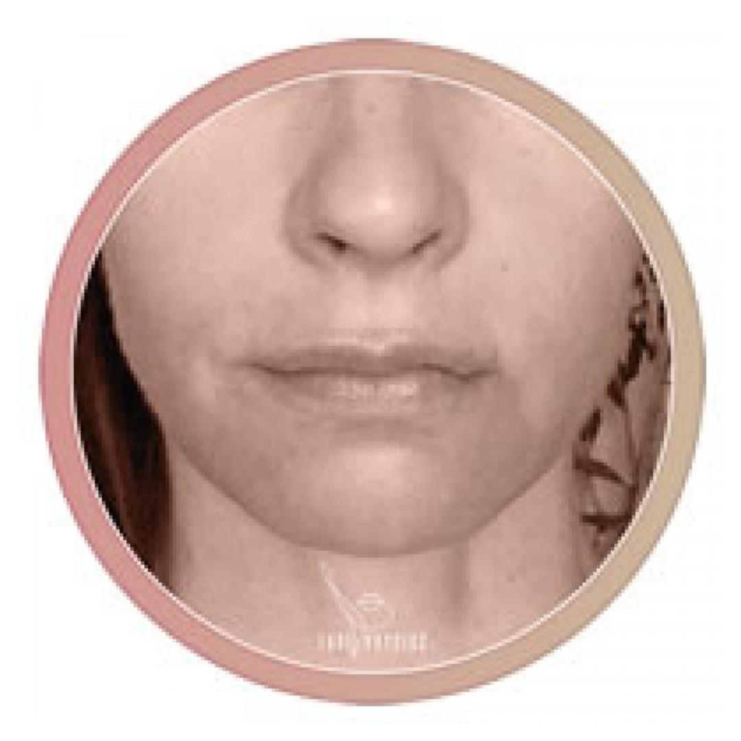 FacePhysics Intensiivikurssi: Ylähuulen kohotus – kuva 1
